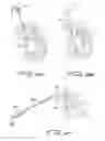 Fig. 19 - DIALYSIS CATHETER