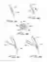 Fig. 28 - DIALYSIS CATHETER