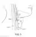Fig. 11 - Methods and systems for establishing retrograde carotid arterial blood flow