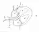 Fig. 02 - Device and method for releasing catheters from cardiac structures