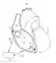 Fig. 01 - Pacing mode switching in a ventricular pacemaker
