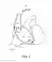 Fig. 02 - Pacing mode switching in a ventricular pacemaker