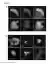 Fig. 06 - Methods and compositions for converting non-endocrine pancreatic tissue into insulin-producing cells