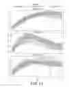 Fig. 14 - METHOD OF DETECTION OF OCCULT PANCREATIC BETA CELL DYSFUNCTION IN NORMOGLYCEMIC PATIENTS