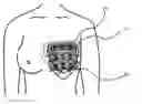Fig. 01 - Device for detecting blood flow disturbance