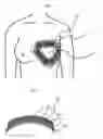 Fig. 06 - Device for detecting blood flow disturbance