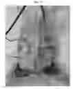 Fig. 09 - Device for detecting blood flow disturbance