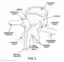 Fig. 03 - SUBLAMINAR SPINAL FIXATION SYSTEM AND METHOD OF USE