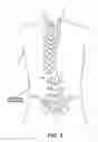 Fig. 04 - SUBLAMINAR SPINAL FIXATION SYSTEM AND METHOD OF USE