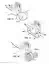 Fig. 11 - SUBLAMINAR SPINAL FIXATION SYSTEM AND METHOD OF USE