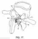 Fig. 12 - SUBLAMINAR SPINAL FIXATION SYSTEM AND METHOD OF USE