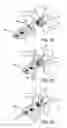 Fig. 13 - SUBLAMINAR SPINAL FIXATION SYSTEM AND METHOD OF USE
