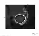 Fig. 06 - Evaluating prosthetic heart valve placement