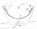 Fig. 01 - Horizontal osteotomy implant, and methods of using the same