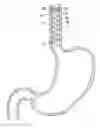 Fig. 01 - Esophageal sleeve