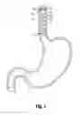 Fig. 02 - Esophageal sleeve