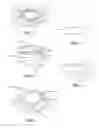 Fig. 02 - Hydrophilic AIOL with bonding