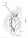 Fig. 17 - Modular intraocular lens designs, tools and methods