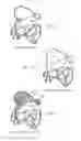 Fig. 10 - Prosthetic heart valve
