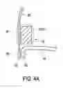 Fig. 04 - Transcatheter valve prosthesis
