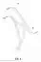 Fig. 09 - Transcatheter valve prosthesis