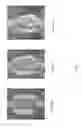 Fig. 07 - Compression resistant implants including an oxysterol and methods of use