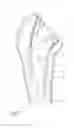 Fig. 04 - Surgical shoulder articulation replacement method