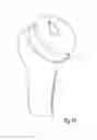 Fig. 09 - Surgical shoulder articulation replacement method