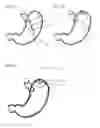 Fig. 07 - Systems and methods for magnetically positioning a gastric device