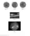 Fig. 02 - Method of treating macular degeneration using botulinum toxin-based pharmaceuticals