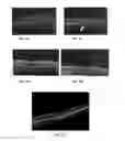 Fig. 07 - Method of treating macular degeneration using botulinum toxin-based pharmaceuticals