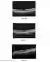 Fig. 08 - Method of treating macular degeneration using botulinum toxin-based pharmaceuticals