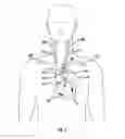 Fig. 02 - Occluding catheter and dynamic method for prevention of stroke