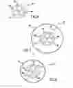 Fig. 07 - Occluding catheter and dynamic method for prevention of stroke