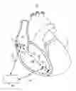 Fig. 01 - Input switching in a ventricular intracardiac pacemaker