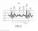 Fig. 06 - Input switching in a ventricular intracardiac pacemaker