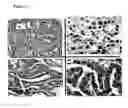 Fig. 02 - Methods for treatment of metastatic thyroid cancer using a PDGFR-α inhibitor