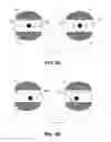 Fig. 04 - Ophthalmic system having adjustable accommodation based on photodetection