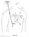 Fig. 02 - Hydrostatic offset adjustment for measured cardiovascular pressure values