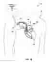 Fig. 03 - Hydrostatic offset adjustment for measured cardiovascular pressure values