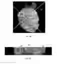 Fig. 04 - Intervolume lesion detection and image preparation