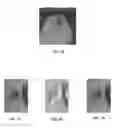 Fig. 08 - Intervolume lesion detection and image preparation