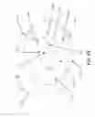 Fig. 45 - Device and System for Placing Securing Device Within Bone