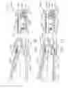 Fig. 19 - Surgical instrument comprising improved jaw control