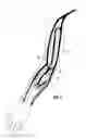 Fig. 02 - Magnetically activated arteriovenous access valve system and related methods