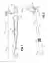 Fig. 02 - Scanning ureteroscope for maximizing efficiency in laser lithotripsy