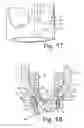 Fig. 16 - Pivotal bone anchor with bottom-loaded shank and tool-deployable interference fit rod-engaging insert