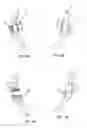 Fig. 04 - Bone hook apparatus