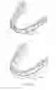 Fig. 02 - Aligners with enhanced gable bends