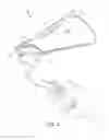 Fig. 02 - Device for the delivery of a prosthetic implant and method of use thereof